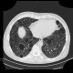 Lymphocytic interstitial pneumonia, cystic lung disease: CT - Computed tomography