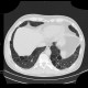 Lymphocytic interstitial pneumonia, cystic lung disease: CT - Computed tomography