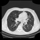 Lymphocytic interstitial pneumonia, cystic lung disease: CT - Computed tomography