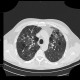 Lymphocytic interstitial pneumonia, cystic lung disease: CT - Computed tomography