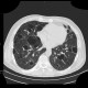 Lymphocytic interstitial pneumonia, cystic lung disease: CT - Computed tomography