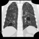 Lymphocytic interstitial pneumonia, cystic lung disease: CT - Computed tomography