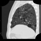 Lymphocytic interstitial pneumonia, cystic lung disease: CT - Computed tomography