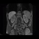 Cystic nephroma, Perlmann's tumour, hemangioma of liver: MRI - Magnetic Resonance Imaging