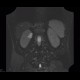 Cystic nephroma, Perlmann's tumour, hemangioma of liver: MRI - Magnetic Resonance Imaging