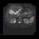 Cystic nephroma, Perlmann's tumour, hemangioma of liver: MRI - Magnetic Resonance Imaging