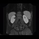 Cystic nephroma, Perlmann's tumour, hemangioma of liver: MRI - Magnetic Resonance Imaging