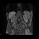 Cystic nephroma, Perlmann's tumour, hemangioma of liver: MRI - Magnetic Resonance Imaging