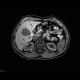 Cystic nephroma, Perlmann's tumour, hemangioma of liver: MRI - Magnetic Resonance Imaging