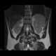 Cystic nephroma, Perlmann's tumour, hemangioma of liver: MRI - Magnetic Resonance Imaging