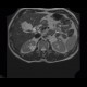 Cystic nephroma, Perlmann's tumour, hemangioma of liver: MRI - Magnetic Resonance Imaging