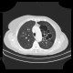 Bronchiectasia, cystic bronchiectasia: CT - Computed tomography