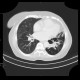 Bronchiectasia, cystic bronchiectasia: CT - Computed tomography