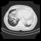 Bronchiectasia, cystic bronchiectasia: CT - Computed tomography