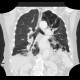 Bronchiectasia, cystic bronchiectasia: CT - Computed tomography