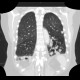 Bronchiectasia, cystic bronchiectasia: CT - Computed tomography