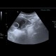 Cystitis, acute cystitis: US - Ultrasound