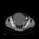 Cyst of ovary, gigantic: CT - Computed tomography