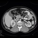 Pancreatic cysts and renal cysts in von Hippel-Lindau disease: CT - Computed tomography