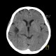 Postischemic gliosis of brain, dense artery: CT - Computed tomography