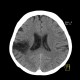 Postischemic gliosis of brain, dense artery: CT - Computed tomography