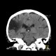 Postischemic gliosis of brain, dense artery: CT - Computed tomography