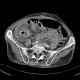 Diffuse peritonitis, dehiscence of rectal anastomosis: CT - Computed tomography