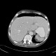 Diffuse peritonitis, dehiscence of rectal anastomosis: CT - Computed tomography