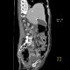 Diffuse peritonitis, dehiscence of rectal anastomosis: CT - Computed tomography