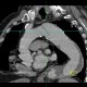 Aortic dissection, Standford B, dissecting aneurysm, re-entry: CT - Computed tomography