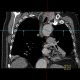 Aortic dissection, Standford B, dissecting aneurysm, re-entry: CT - Computed tomography