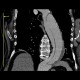 Aortic dissection, Standford B, dissecting aneurysm, re-entry, CPR: CT - Computed tomography