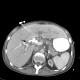 Displacement of duodenobiliary drain: CT - Computed tomography