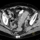 Diverticulitis, acute diverticulitis, peritonitis: CT - Computed tomography