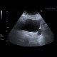 Diverticulum of urinary bladder: US - Ultrasound