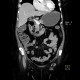 Diverticulum of duodenum: CT - Computed tomography