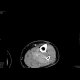 DLBCL of bone and muscle: CT - Computed tomography