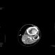 DLBCL of bone and muscle: CT - Computed tomography