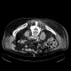 Spondylodiscitis, abscess of psoas muscle, drainage of abscess: CT - Computed tomography
