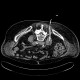 Spondylodiscitis, abscess of psoas muscle, drainage of abscess: CT - Computed tomography