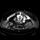 Spondylodiscitis, abscess of psoas muscle, drainage of abscess: CT - Computed tomography