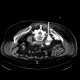 Spondylodiscitis, abscess of psoas muscle, drainage of abscess: CT - Computed tomography