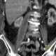 Spondylodiscitis, abscess of psoas muscle, drainage of abscess: CT - Computed tomography