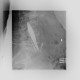 Spondylodiscitis, abscess of psoas muscle, drainage of abscess: X-ray - Plain radiograph