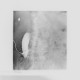 Spondylodiscitis, abscess of psoas muscle, drainage of abscess: X-ray - Plain radiograph