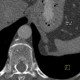 Diaphragmatic hernia, diaphragm: CT - Computed tomography