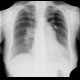 Atrial septal defect on chest radiograph: X-ray - Plain radiograph