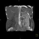 Duplex kidney: CT - Computed tomography