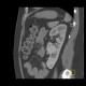 Duplex kidney: CT - Computed tomography