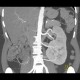 Duplex kidney: CT - Computed tomography